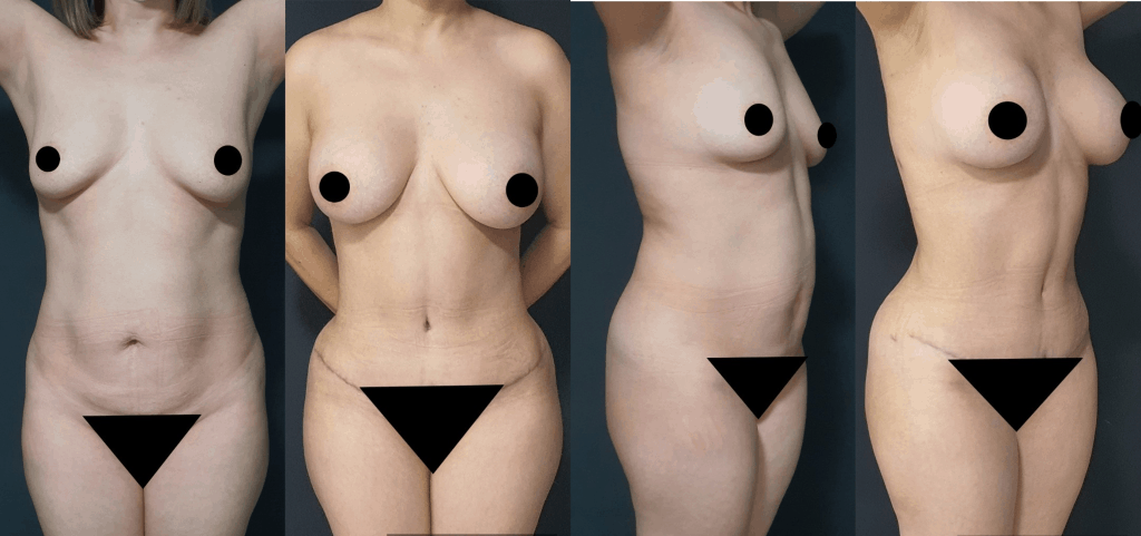 Abdominoplastia-1